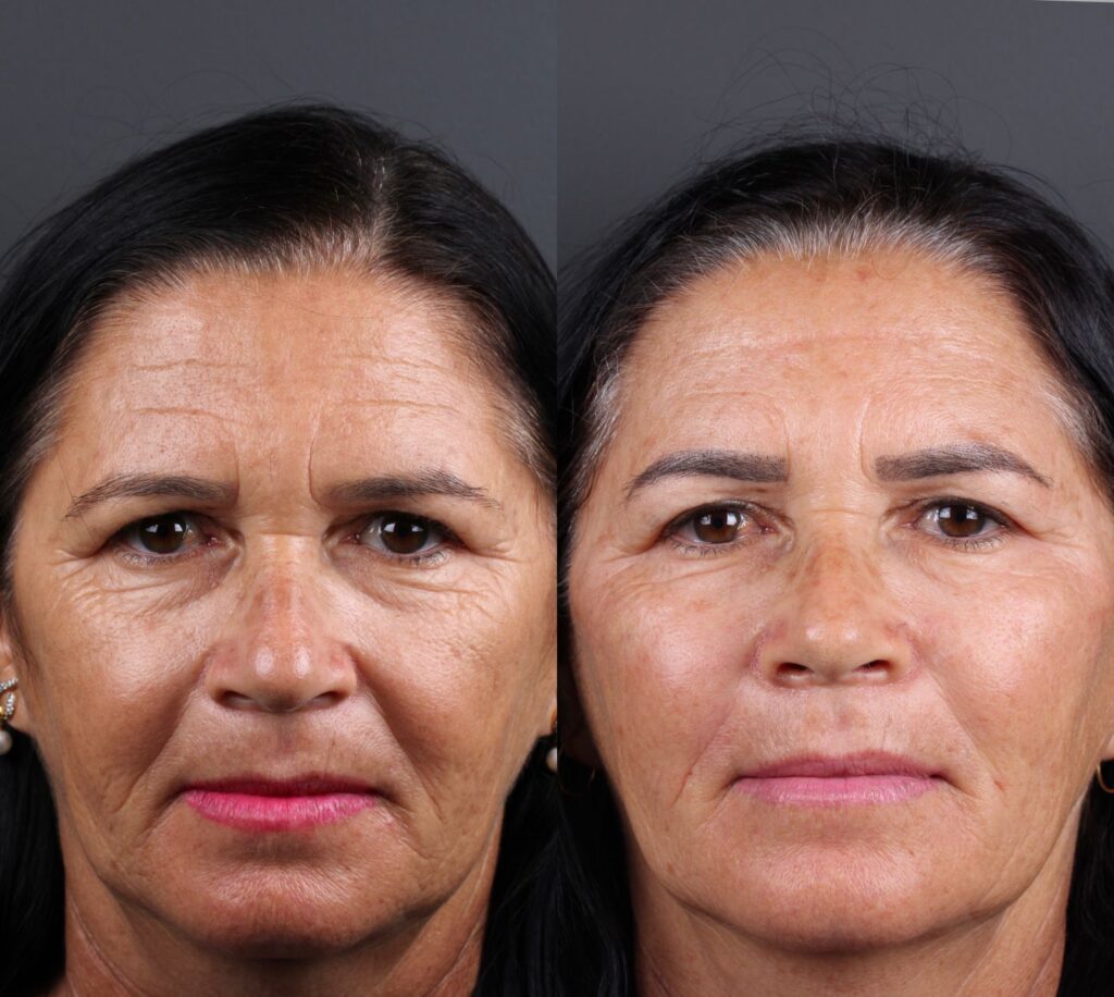 Antes e depois de paciente de preenchimento