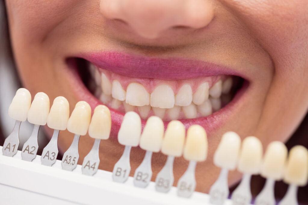 Dentista comparando cor do dente de paciente antes do tratamento
