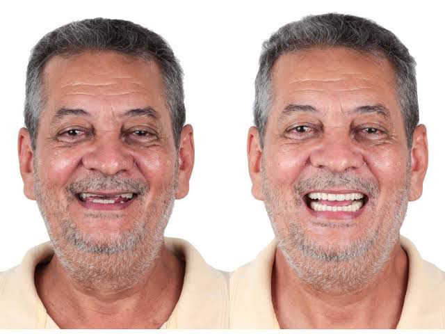 Antes e depois paciente de implante dentário