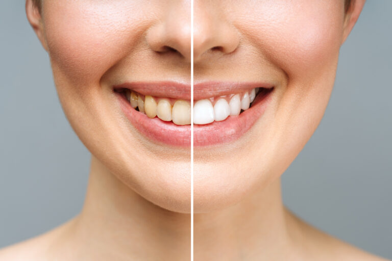Antes e depois de clareamento dental